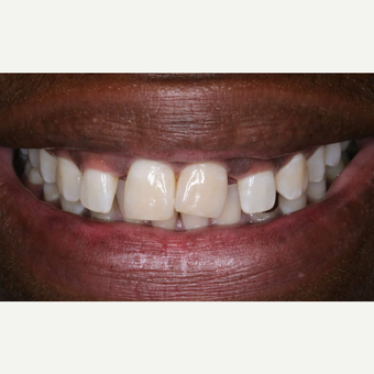 35-44 year old man treated with Porcelain Veneers before 3629777
