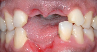 Male Before/After Dental Implants before 1006825