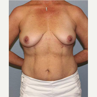 35-44 year old woman treated with Breast Lift before 3141595
