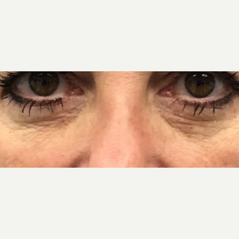 Intensif Radio Frequency Micro Needling with PRP (platelet rich plasma) to thicken and rejuvenate skin around the eyes and mouth before 3841178