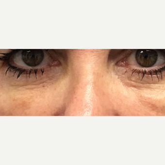 Intensif Radio Frequency Micro Needling with PRP (platelet rich plasma) to thicken and rejuvenate skin around the eyes and mouth after 3841178
