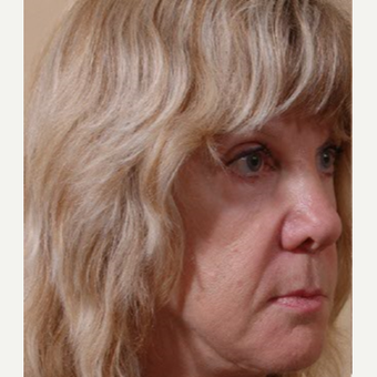 55-64 year old woman treated with Cheek Augmentation before 3749043