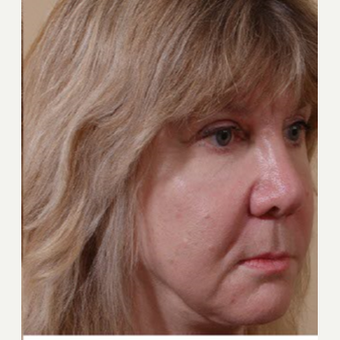 55-64 year old woman treated with Cheek Augmentation after 3749043