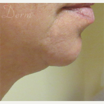45-54 year old woman treated with Kybella after 3381472