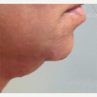45-54 year old woman treated with Kybella before 3381472