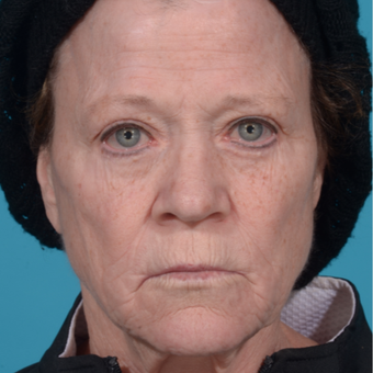 55-64 year old woman treated with Liquid Facelift: Bellafill, Juvederm, and Botox before 2762528