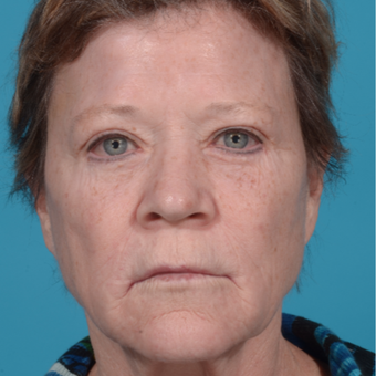 55-64 year old woman treated with Liquid Facelift: Bellafill, Juvederm, and Botox after 2762528