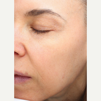 Halo Laser after 1833360