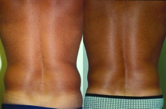 39-year-old man treated with Liposuction. after 574556