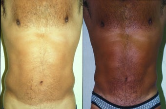 39-year-old man treated with Liposuction. before 574556