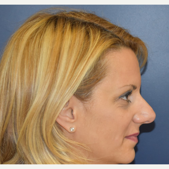 35-44 year old woman treated with Septoplasty before 3131278