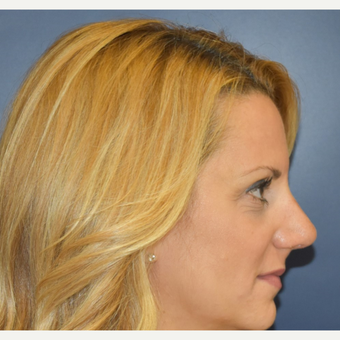 35-44 year old woman treated with Septoplasty after 3131278