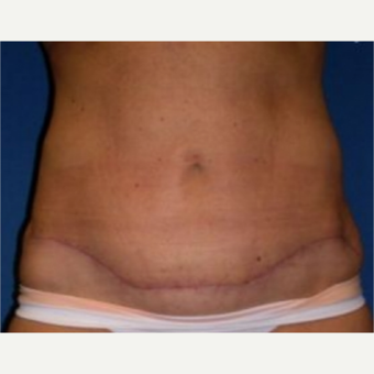 25-34 year old woman treated with Tummy Tuck after 3009852