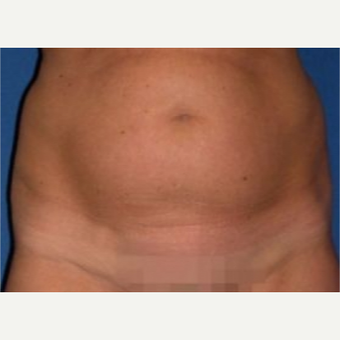 25-34 year old woman treated with Tummy Tuck before 3009852