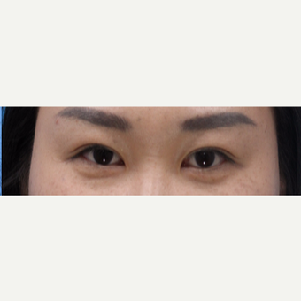 35-44 year old woman treated with Asian Eyelid Surgery after 3606251