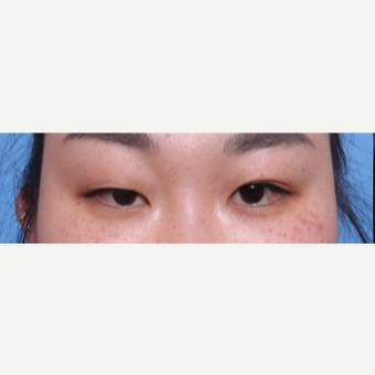 35-44 year old woman treated with Asian Eyelid Surgery before 3606251