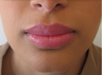 Lip Filler with Juvederm Volbella 1059220