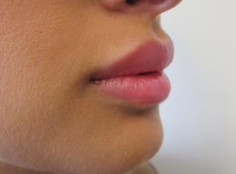 Lip Filler with Juvederm Volbella after 1059220
