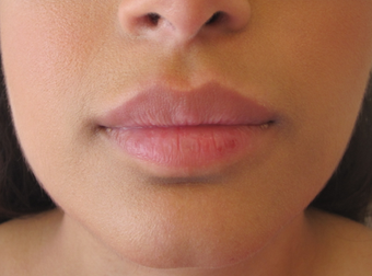 Lip Filler with Juvederm Volbella 1059220