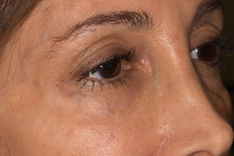 Undereye trough rejuvenation with Belotero after 1479817