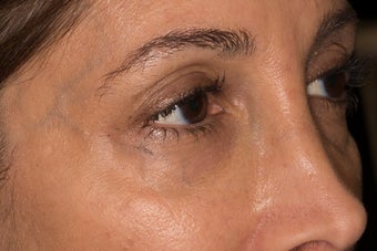 Undereye trough rejuvenation with Belotero before 1479817