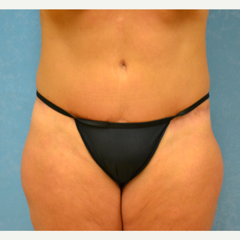 Mother of three finds success with abdominoplasty after 3731895