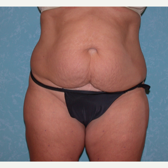 Mother of three finds success with abdominoplasty before 3731895