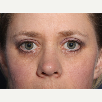 35-44 year old woman treated with Eyelid Surgery (view 1 of 2) after 3246827