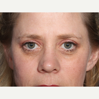 35-44 year old woman treated with Eyelid Surgery (view 1 of 2) before 3246827