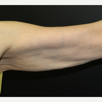 55-64 year old woman treated with ThermiTight to the upper arms after 3398540