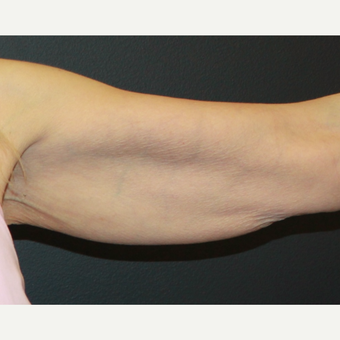 55-64 year old woman treated with ThermiTight to the upper arms before 3398540