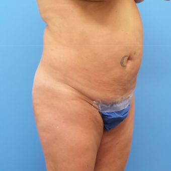 Tummy Tuck with Abdominal and Back Liposuction before 3328213