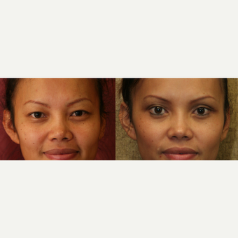 Asian Eyelid surgery before and after pictures before 3424083