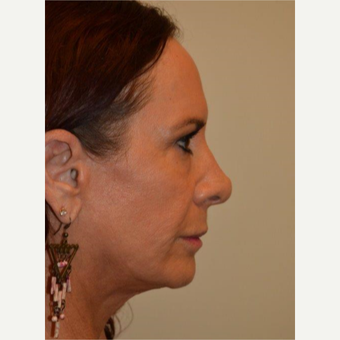 55-64 year old woman treated with Facelift after 3664429