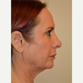 55-64 year old woman treated with Facelift before 3664429