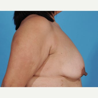 45-54 year old woman treated with Nipple Reduction Surgery before 1851608