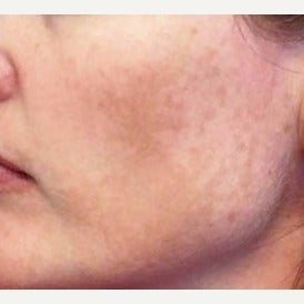 35-44 year old woman treated with Melanage Mini-Peel Melasma Treatment before 2081928