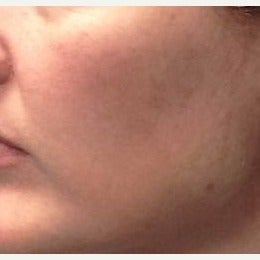 35-44 year old woman treated with Melanage Mini-Peel Melasma Treatment after 2081928