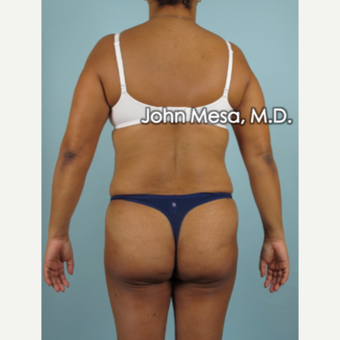 45-54 year old woman treated with Brazilian Butt Lift before 3777633