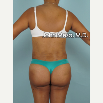 45-54 year old woman treated with Brazilian Butt Lift after 3777633