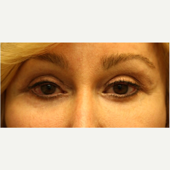 65-74 year old woman treated with Eyelid Surgery after 3139469