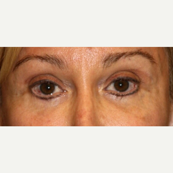 65-74 year old woman treated with Eyelid Surgery before 3139469