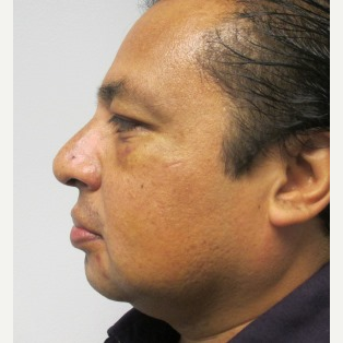 Rhinoplasty after 2993722