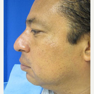 Rhinoplasty before 2993722