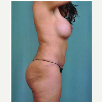 35-44 year old woman treated with Mommy Makeover after 3616622