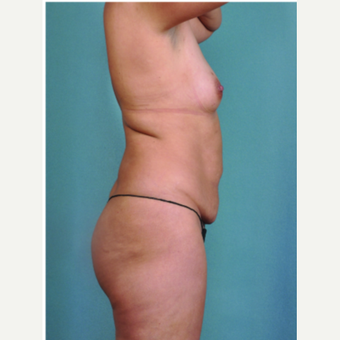 35-44 year old woman treated with Mommy Makeover before 3616622