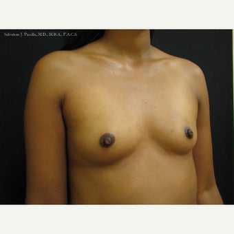 35-44 year old woman with Breast Cancer following Breast Reconstruction 1541561