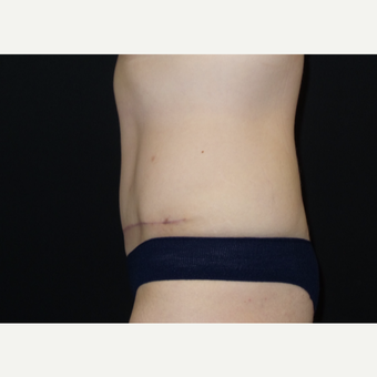 25-34 year old woman treated with Tummy Tuck after 3094370