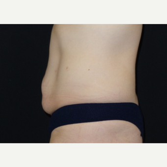 25-34 year old woman treated with Tummy Tuck before 3094370