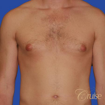 Male breast reduction performed to get rid of puffy nipples before 3502243